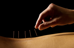 acupuncture